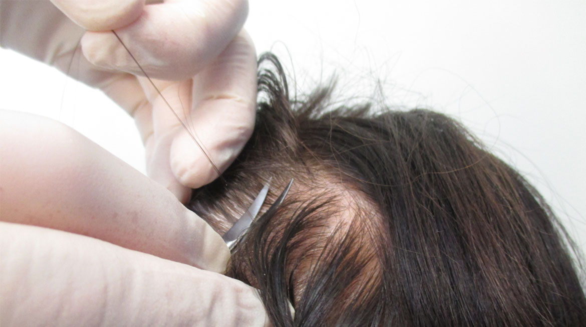 Tricogramma: cos'è e come si effettua l'analisi del capello